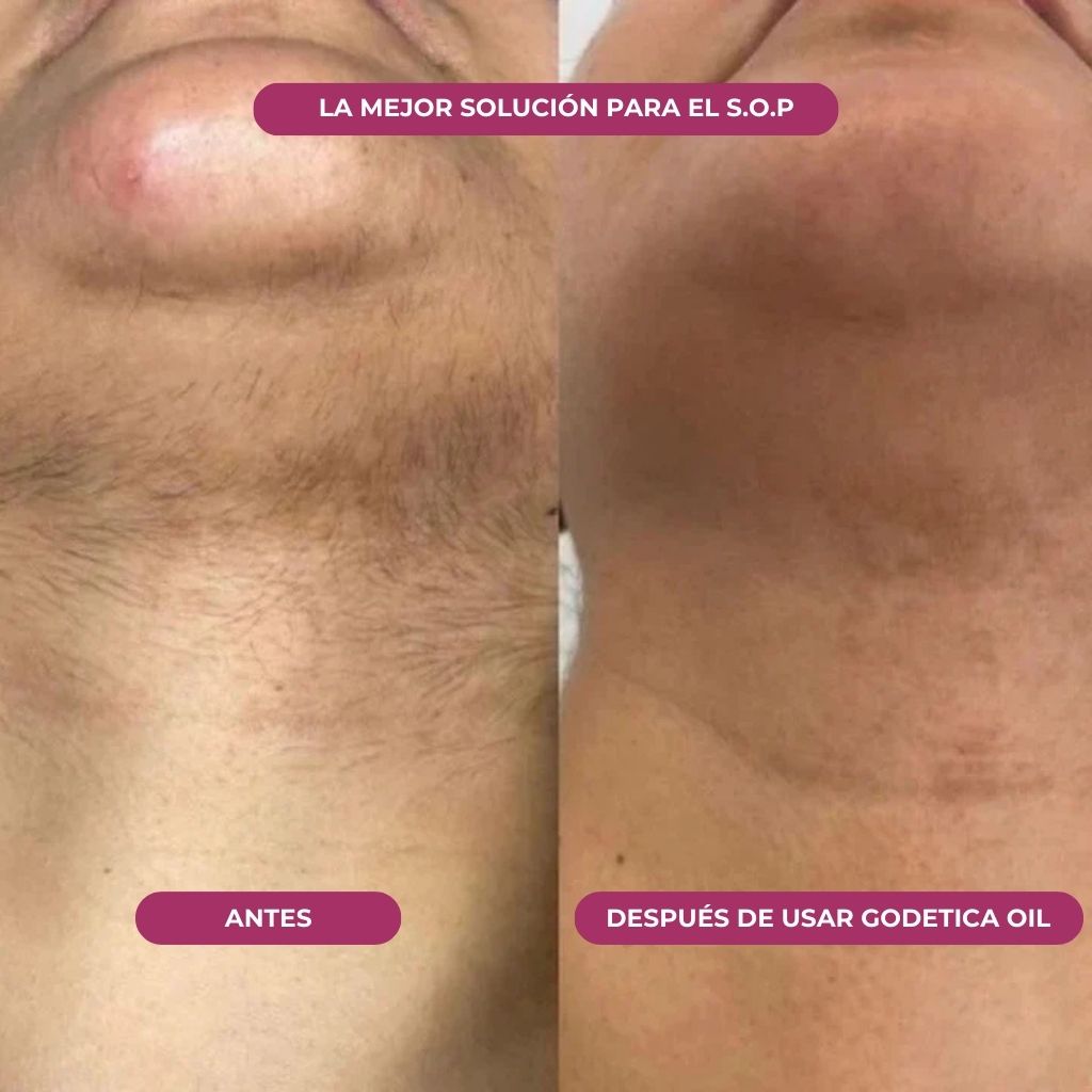 Aceite Godetica™ - Menos Vello, Más Suavidad